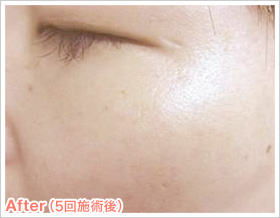 After