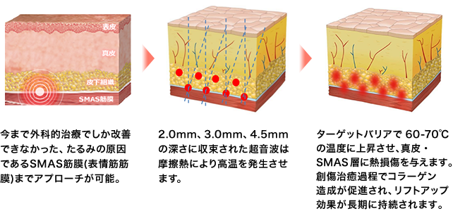 1.今まで外科的治療でしか改善できなかった、たるみの原因であるSMAS筋膜(表情筋筋膜)までアプローチが可能。 2. 1.5mm、3.0mm、4.5mmの深さに収束された超音波は摩擦熱により高温を発生させます。 3. ターゲットバリアで60-70℃の温度に上昇させ、真皮・SMAS層に熱損傷を与えます。創傷治癒過程でコラーゲン造成が促進され、リフトアップ効果が長期に持続されます。