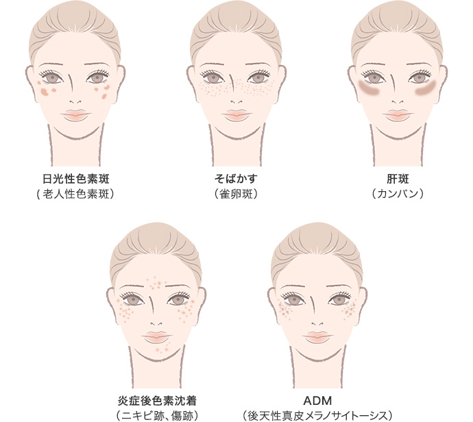 レーザートーニング 自由が丘ロジエクリニック